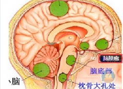 特别嗜睡且嗅觉丧失  警惕脑膜瘤