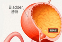 腹胀、腹痛、血尿 原来是膀胱癌在作怪