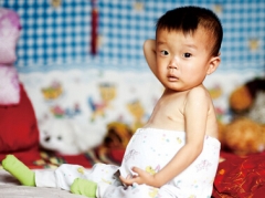 圆鼓鼓的大肚子 原来是患上了戈谢氏病