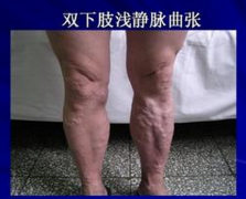 左腿肿涨如同大象腿 小心深静脉血栓来袭