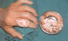 长期饮食无节制 “痛风石”盯上或有截肢风险