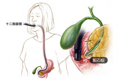 上腹疼痛以为是胃病 不料查出胆石症