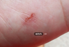 小竹子扎进农妇手 10天后呼吸困难感染破伤风