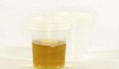 一直想上厕所还有排尿困难，我这是得了膀胱癌