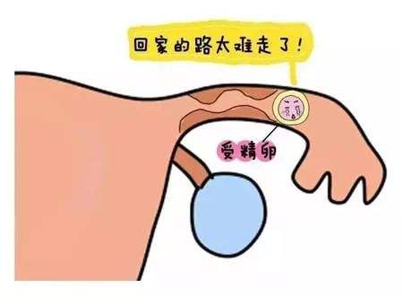 输卵管堵塞壶腹部有积水