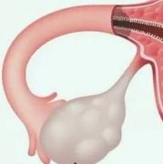 国际研究团队发现:衣原体感染可能导致卵巢癌