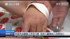 林俊杰得手足口病,你对这种病了解多少?它并非是儿童专属病